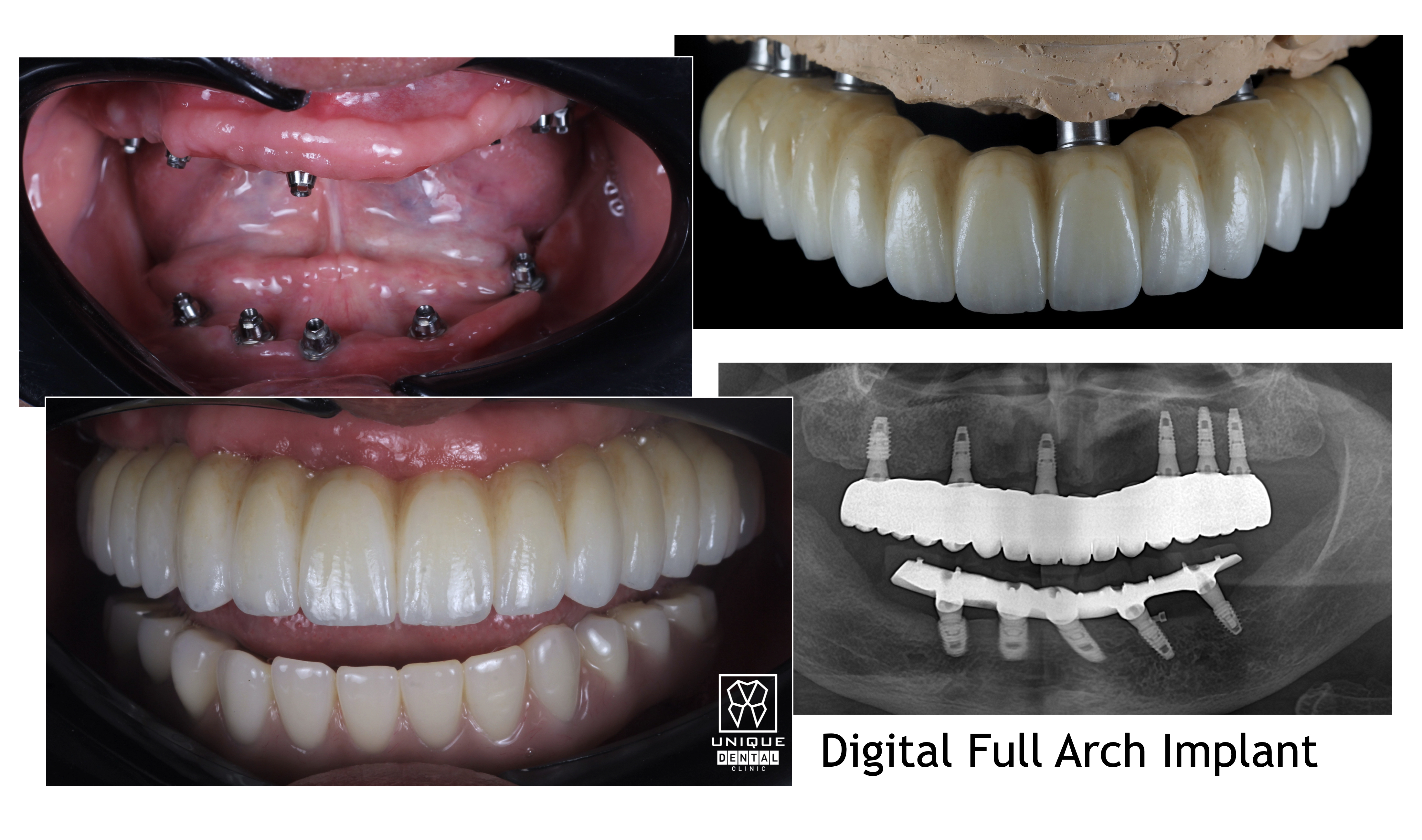 Implant and Others